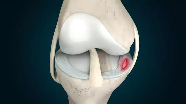 علاج الغضروف القطني
